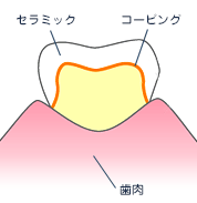 セラミック修復イメージ