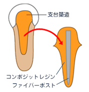 セラミック修復イメージ