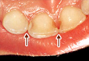 虫歯の例2