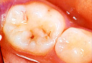 虫歯の例4