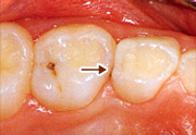 虫歯の例5