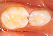 虫歯の例6