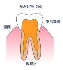 補強イメージ