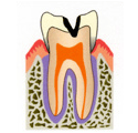 エナメル質に完全に穴が開き、象牙質まで虫歯が広がった状態