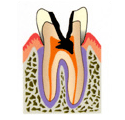 虫歯が歯髄まで進入、つまり歯髄が細菌感染をおこした状態