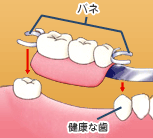 クラスプイメージ