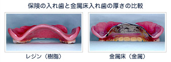 保険の入れ歯と金属床入れ歯の厚さの比較