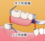 機械式アタッチメント入れ歯イメージ