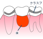 入れ歯イメージ