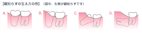 親知らずイメージ