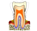 歯周病イメージ