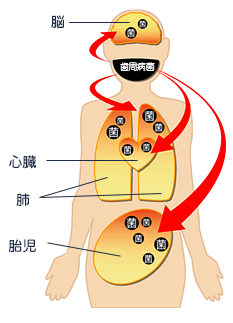 歯周病と全身疾患イメージ