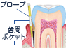 歯周ポケットイメージ